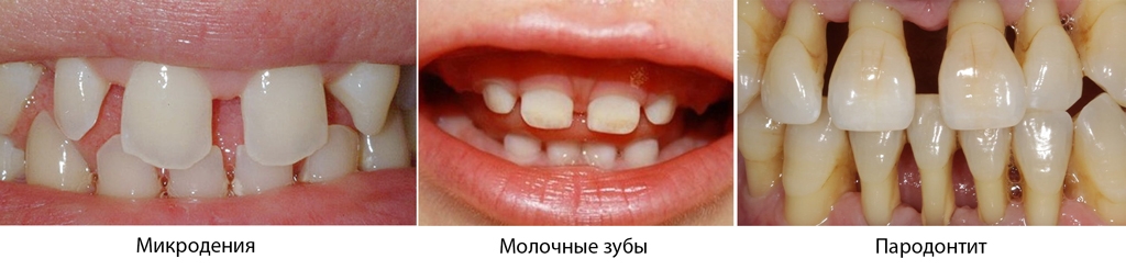 Причины щелей между зубами
