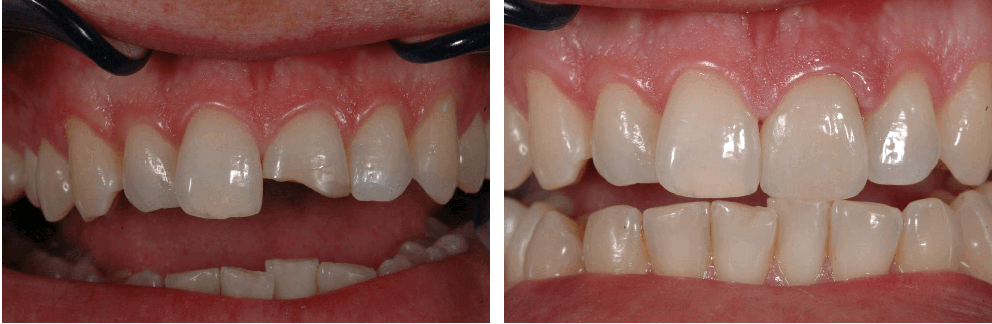 Пример художественной реставрации зубов