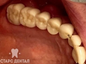 до и после установки зубного протеза