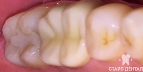 после лечения скола зуба