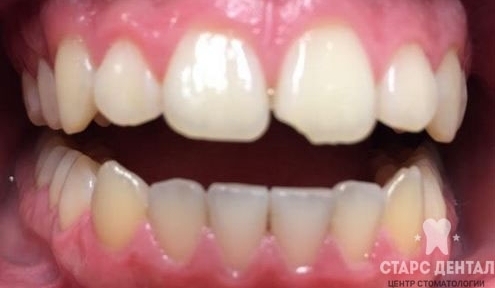 фото до лечения скола зуба