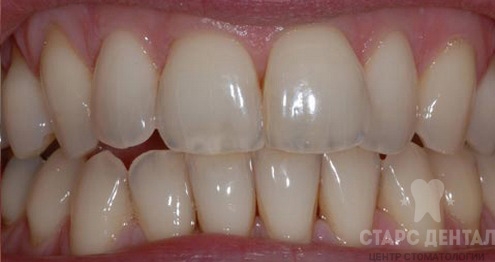 Восстановление эмали зубов до