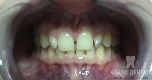 исправление промежутков между зубами до