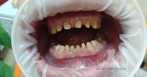 до и после протезирования зубов