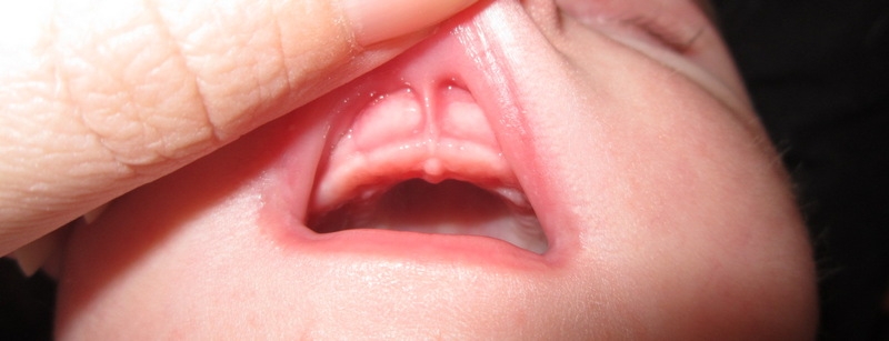короткая уздечка губы у ребенка
