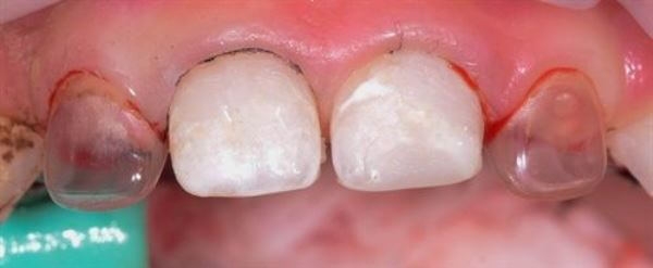 Протезирование детских зубов