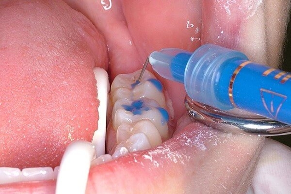 Герметизация зубов