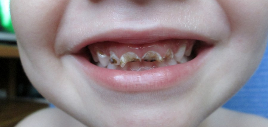 Крошатся зубы у детей
