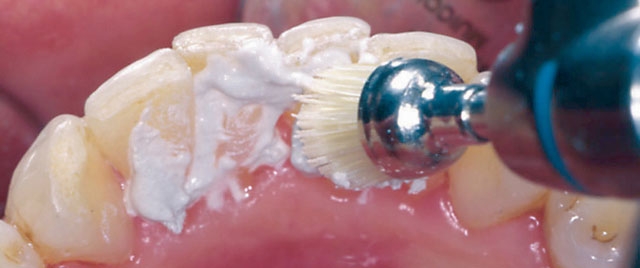 Полировка поверхности зубов