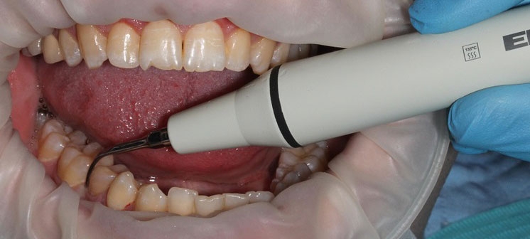 Снятие зубного камня ультразвуком