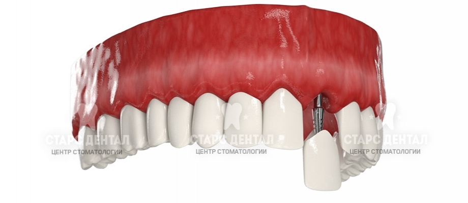 Имплантация с немедленной нагрузкой - новый зуб за 3 дня