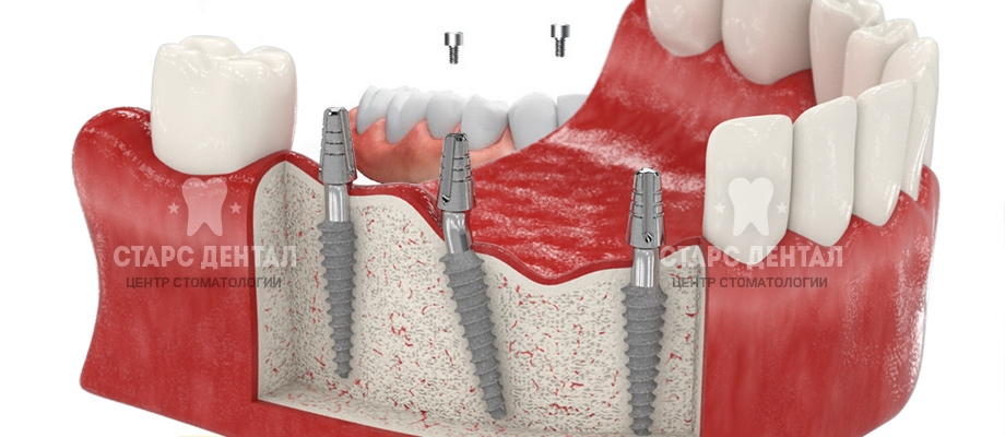 Акция на восстановление сегмента зубов с помощью базальных имплантов Biomed в Москве!