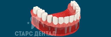 Базальная имплантация зубов одноэтапным (однофазным) методом с немедленной нагрузкой протезом