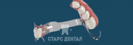 Бюгельные протезы: виды, стоимость от 40 000р. за 1 челюсть в Москве