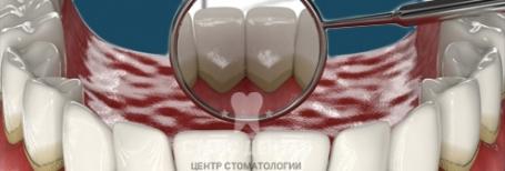 Зубной камень и налёт: способы удаления и профилактика образования. Профессиональная чистка зубов.
