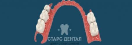 Безакриловый зубной протез Acry Free: показания и применение. Клиника ст. м. Краснопресненская.