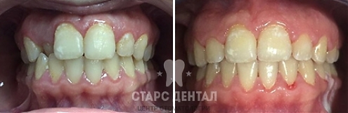 Пример проведения исправления зубов в StarsDental. ФОТО ДО И ПОСЛЕ