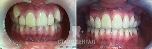 Пример исправления выпирающих клыков фото до и после лечения