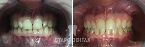 Пример проведения исправления промежутков между зубами - фото до и после