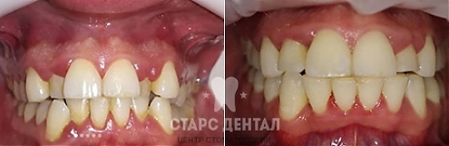 Пример лечения дистопии зубов - фото до и после