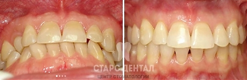 Пример исправления повернутых набок нижних зубов - фото до и после