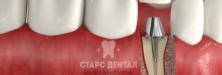 Восстановление зуба на культевой вкладке под коронку. Цена в Москве ст. м. Красносельская.