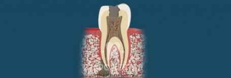 Периодонтит: надежные методы лечения, как сохранить зуб?
