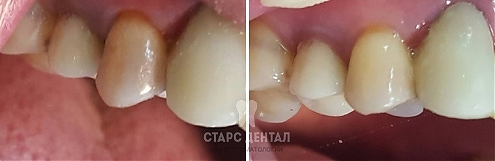 Внутриканальное отбеливание зубов - ФОТО ДО И ПОСЛЕ