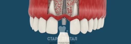 Имплантация с немедленным протезированием (экспресс, базальная). Стоимость восстановления зубов в Москве.