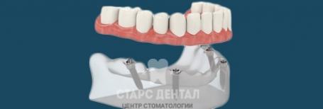 Протезирование на имплантах методом All-on-4. Стоимость восстановления зубов в Москве.