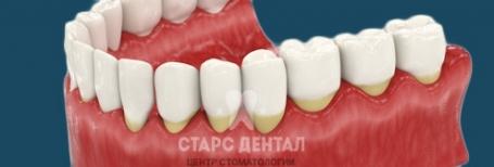 Рецессия десны и её пластика в стоматологии. Как проводится и стоимость операции.