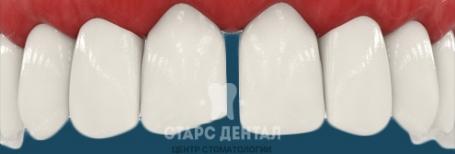 Щель между зубами: причины, диагностика и лечение. Как избавиться от диастемы?