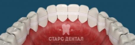 Что такое шинирование зубов? Показания для проведения и цена в Москве.