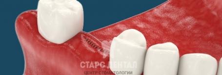 Удаление зубов любой сложности без боли в Москве