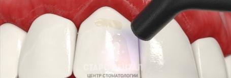 Новейшие методы укрепления эмали зубов в стоматологии на ст. м. Краснопресненская