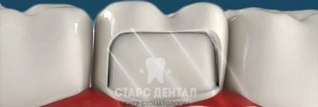 Зубные коронки из металлокерамики для восстановления зубов. Стоматология Stars Dental в Москве.
