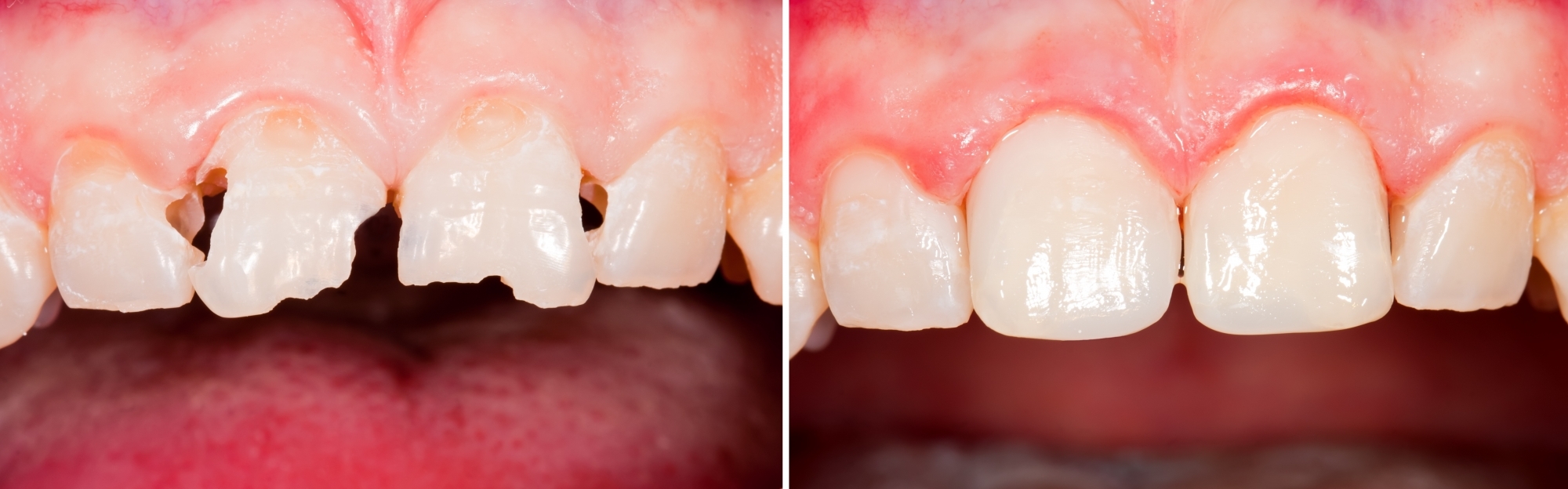 Художественная реставрация зубов фото до и после