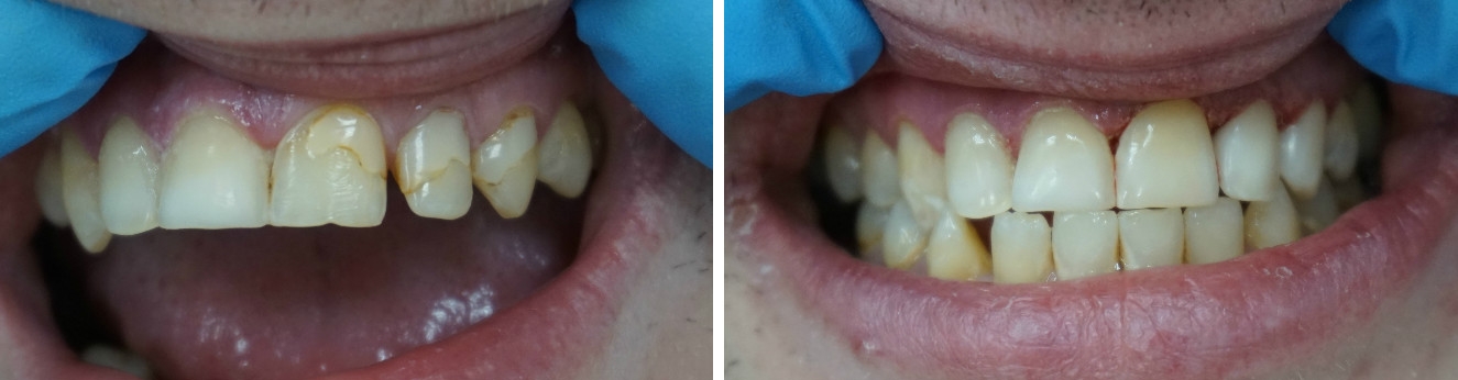 Пример реставрированного зуба