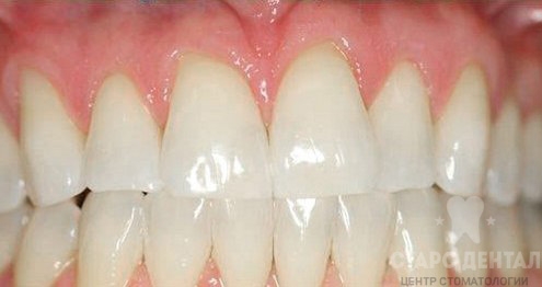 Результаты отбеливания зубов