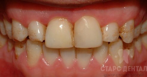 Восстановление эмали зубов до