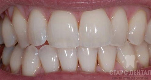 Восстановление эмали зубов после