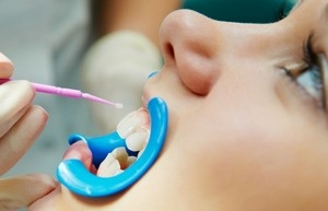 фторирование молочных зубов