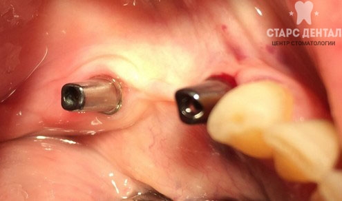 установка зубного моста на имплантах