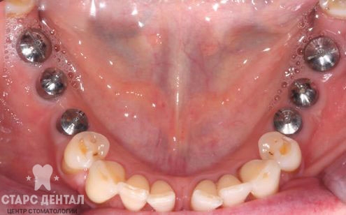 пример немедленной имплантации зубов