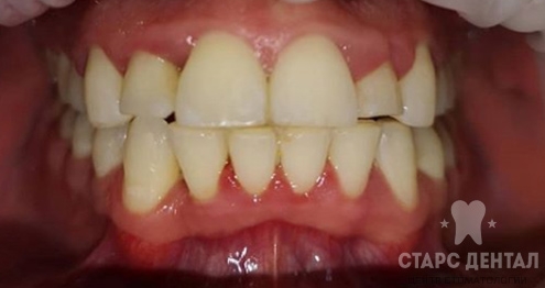 исправление дистопии зубов после