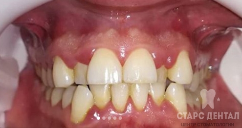исправление дистопии зубов до