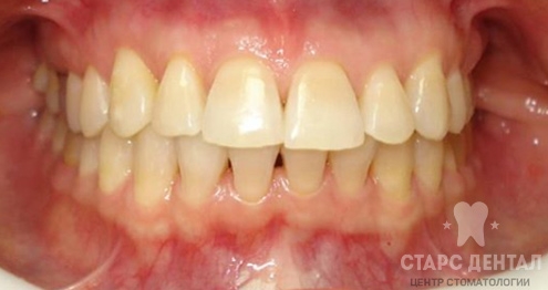 исправление повернутых набок зубов после