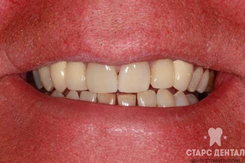 пример проведенной реставрации зубов
