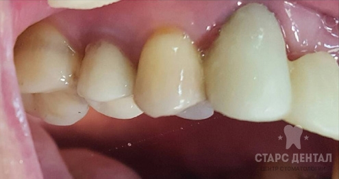 Результаты внутриканального отбеливания зубов