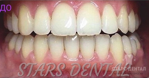 Результаты отбеливания зубов
